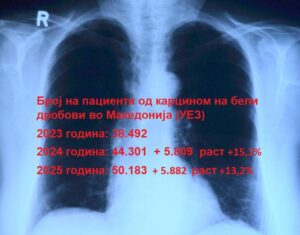Повторно сериозен пораст на заболени од карцином на бели дробови, нови 6 илјади болни за една година